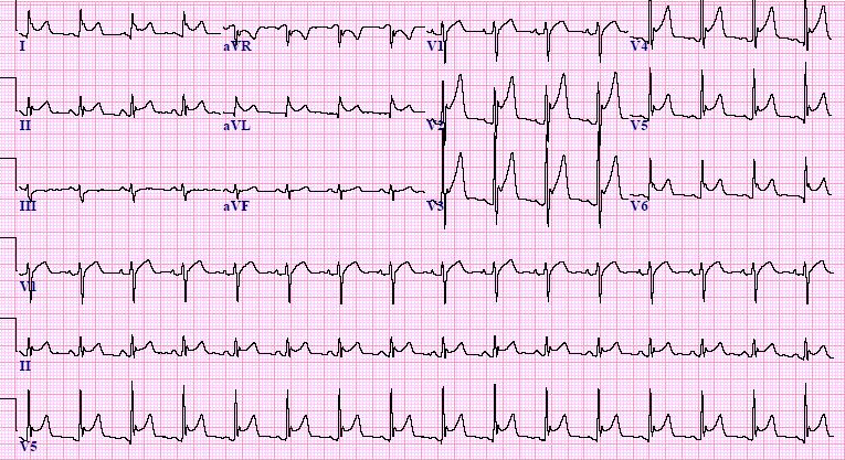 Physical Activity Recommendations In Patients With Acute Pericarditis ...